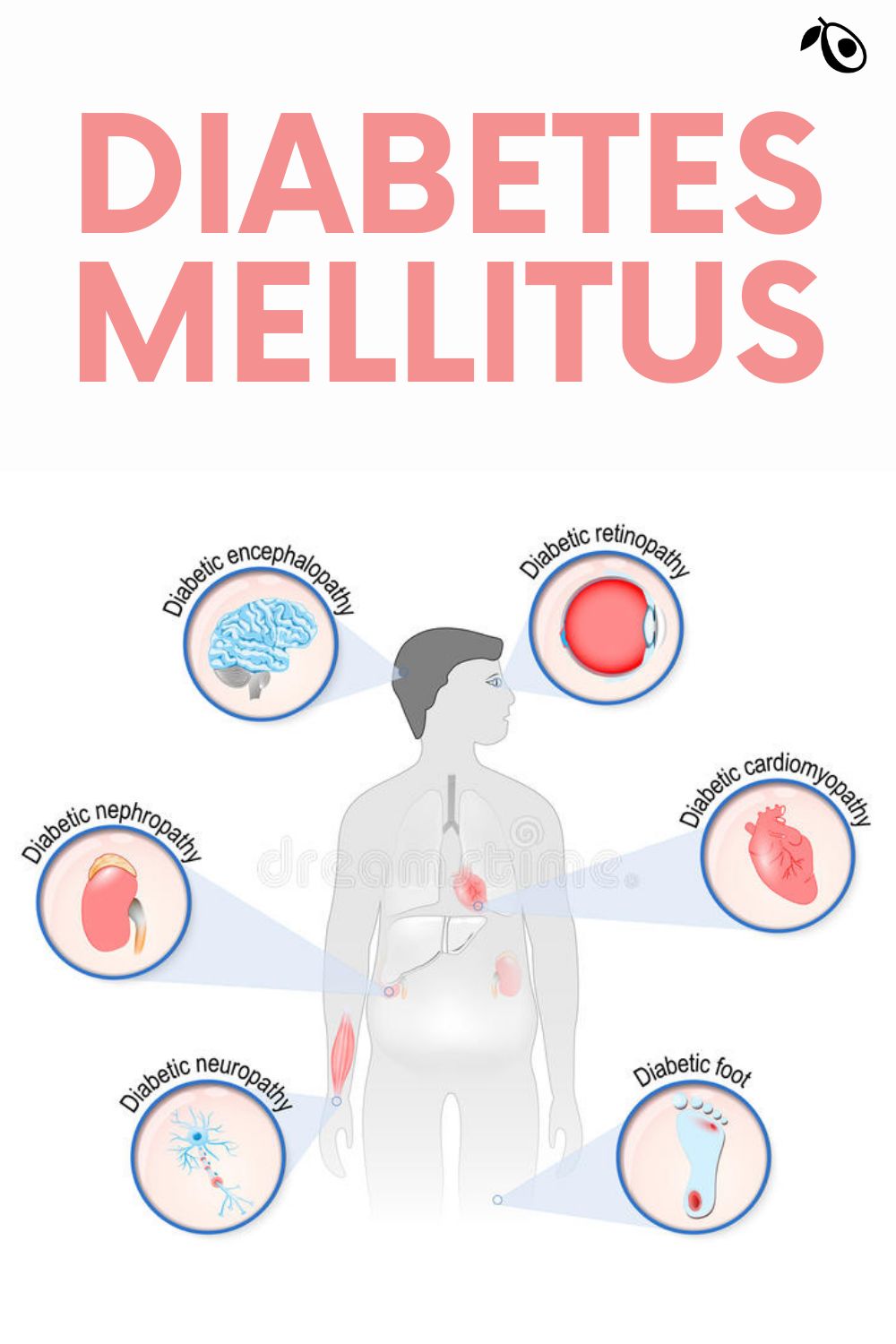 Diabetes mellitus